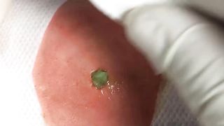 BEST Pimple Popping __ Big Cystic Acne Blackheads __ Whiteheads Removal _ Squeezing Pimples _ H#064 - 0010