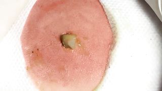 BEST Pimple Popping __ Big Cystic Acne Blackheads __ Whiteheads Removal _ Squeezing Pimples _ H#064 - 0011