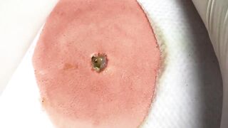 BEST Pimple Popping __ Big Cystic Acne Blackheads __ Whiteheads Removal _ Squeezing Pimples _ H#064 - 0013