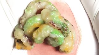 BEST Pimple Popping __ Big Cystic Acne Blackheads __ Whiteheads Removal _ Squeezing Pimples _ H#064 - 0014