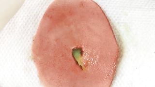 BEST Pimple Popping __ Big Cystic Acne Blackheads __ Whiteheads Removal _ Squeezing Pimples _ H#064 - 0015