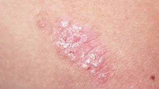 Psoriasis Relief: The Best Remedy For Your Skin
