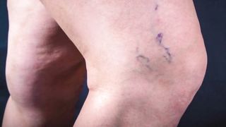 What Causes Varicose Veins & How To Get Rid Of It? – Dr. Berg