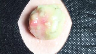 BEST Pimple Popping __ Big Cystic Acne Blackheads __ Whiteheads Removal _ Squeezing Pimples _ H#065 - 001