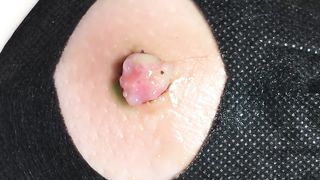 BEST Pimple Popping __ Big Cystic Acne Blackheads __ Whiteheads Removal _ Squeezing Pimples _ H#065 - 002