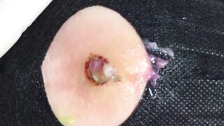 BEST Pimple Popping __ Big Cystic Acne Blackheads __ Whiteheads Removal _ Squeezing Pimples _ H#065 - 006