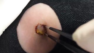 BEST Pimple Popping __ Big Cystic Acne Blackheads __ Whiteheads Removal _ Squeezing Pimples _ H#065 - 007
