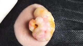 BEST Pimple Popping __ Big Cystic Acne Blackheads __ Whiteheads Removal _ Squeezing Pimples _ H#065 - 008