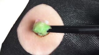 BEST Pimple Popping __ Big Cystic Acne Blackheads __ Whiteheads Removal _ Squeezing Pimples _ H#065 - 009