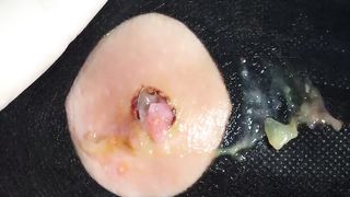 BEST Pimple Popping __ Big Cystic Acne Blackheads __ Whiteheads Removal _ Squeezing Pimples _ H#065 - 0010