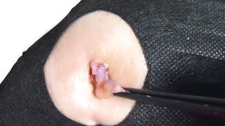 BEST Pimple Popping __ Big Cystic Acne Blackheads __ Whiteheads Removal _ Squeezing Pimples _ H#065 - 0011