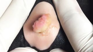 BEST Pimple Popping __ Big Cystic Acne Blackheads __ Whiteheads Removal _ Squeezing Pimples _ H#065 - 0013