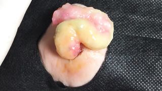 BEST Pimple Popping __ Big Cystic Acne Blackheads __ Whiteheads Removal _ Squeezing Pimples _ H#065 - 0014