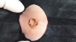 BEST Pimple Popping __ Big Cystic Acne Blackheads __ Whiteheads Removal _ Squeezing Pimples _ H#065 - 0015