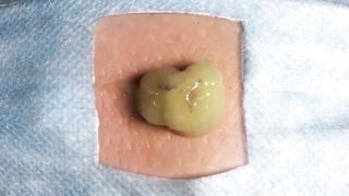 BEST Pimple Popping __ Big Cystic Acne Blackheads __ Whiteheads Removal _ Squeezing Pimples _ H#066 - 001