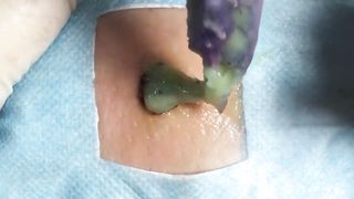 BEST Pimple Popping __ Big Cystic Acne Blackheads __ Whiteheads Removal _ Squeezing Pimples _ H#066 - 002