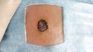 BEST Pimple Popping __ Big Cystic Acne Blackheads __ Whiteheads Removal _ Squeezing Pimples _ H#066 - 003