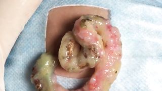 BEST Pimple Popping __ Big Cystic Acne Blackheads __ Whiteheads Removal _ Squeezing Pimples _ H#066 - 004