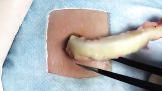 BEST Pimple Popping __ Big Cystic Acne Blackheads __ Whiteheads Removal _ Squeezing Pimples _ H#066 - 005