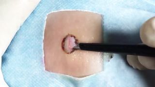 BEST Pimple Popping __ Big Cystic Acne Blackheads __ Whiteheads Removal _ Squeezing Pimples _ H#066 - 006
