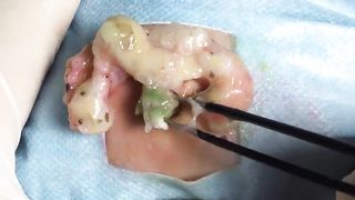 BEST Pimple Popping __ Big Cystic Acne Blackheads __ Whiteheads Removal _ Squeezing Pimples _ H#066 - 007