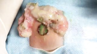 BEST Pimple Popping __ Big Cystic Acne Blackheads __ Whiteheads Removal _ Squeezing Pimples _ H#066 - 008