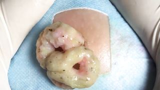 BEST Pimple Popping __ Big Cystic Acne Blackheads __ Whiteheads Removal _ Squeezing Pimples _ H#066 - 009
