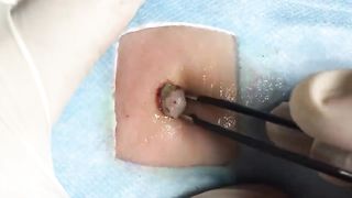 BEST Pimple Popping __ Big Cystic Acne Blackheads __ Whiteheads Removal _ Squeezing Pimples _ H#066 - 0010