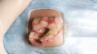 BEST Pimple Popping __ Big Cystic Acne Blackheads __ Whiteheads Removal _ Squeezing Pimples _ H#066 - 0113
