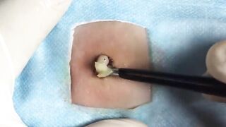 BEST Pimple Popping __ Big Cystic Acne Blackheads __ Whiteheads Removal _ Squeezing Pimples _ H#066 - 012