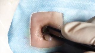 BEST Pimple Popping __ Big Cystic Acne Blackheads __ Whiteheads Removal _ Squeezing Pimples _ H#066 - 013