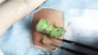 BEST Pimple Popping __ Big Cystic Acne Blackheads __ Whiteheads Removal _ Squeezing Pimples _ H#066 - 014