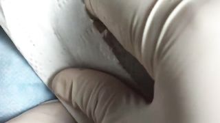 BEST Pimple Popping __ Big Cystic Acne Blackheads __ Whiteheads Removal _ Squeezing Pimples _ H#066 - 015