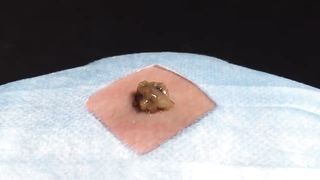BEST Pimple Popping __ Big Cystic Acne Blackheads __ Whiteheads Removal _ Squeezing Pimples _ H#069 - 001