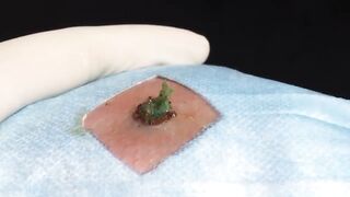 BEST Pimple Popping __ Big Cystic Acne Blackheads __ Whiteheads Removal _ Squeezing Pimples _ H#069 - 002