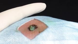 BEST Pimple Popping __ Big Cystic Acne Blackheads __ Whiteheads Removal _ Squeezing Pimples _ H#069 - 003