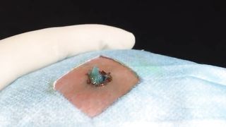 BEST Pimple Popping __ Big Cystic Acne Blackheads __ Whiteheads Removal _ Squeezing Pimples _ H#069 - 004