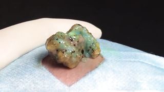 BEST Pimple Popping __ Big Cystic Acne Blackheads __ Whiteheads Removal _ Squeezing Pimples _ H#069 - 005