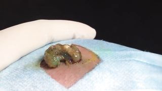 BEST Pimple Popping __ Big Cystic Acne Blackheads __ Whiteheads Removal _ Squeezing Pimples _ H#069 - 006