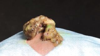 BEST Pimple Popping __ Big Cystic Acne Blackheads __ Whiteheads Removal _ Squeezing Pimples _ H#069 - 008