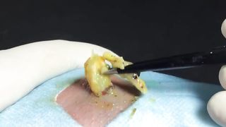 BEST Pimple Popping __ Big Cystic Acne Blackheads __ Whiteheads Removal _ Squeezing Pimples _ H#069 - 009
