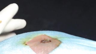 BEST Pimple Popping __ Big Cystic Acne Blackheads __ Whiteheads Removal _ Squeezing Pimples _ H#069 - 010