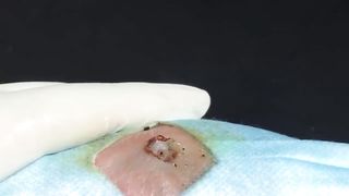 BEST Pimple Popping __ Big Cystic Acne Blackheads __ Whiteheads Removal _ Squeezing Pimples _ H#069 - 011