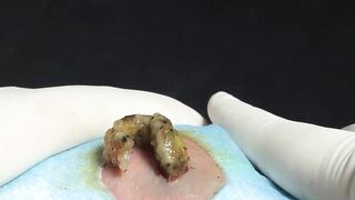 BEST Pimple Popping __ Big Cystic Acne Blackheads __ Whiteheads Removal _ Squeezing Pimples _ H#069 - 012
