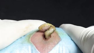 BEST Pimple Popping __ Big Cystic Acne Blackheads __ Whiteheads Removal _ Squeezing Pimples _ H#069 - 013