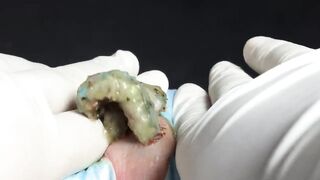 BEST Pimple Popping __ Big Cystic Acne Blackheads __ Whiteheads Removal _ Squeezing Pimples _ H#069 - 015
