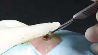 BEST Pimple Popping __ Big Cystic Acne Blackheads __ Whiteheads Removal _ Squeezing Pimples _ H#069 - 014