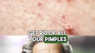 Things u need to do to remove acne