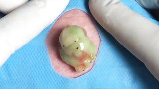 BEST Pimple Popping __ Big Cystic Acne Blackheads __ Whiteheads Removal _ Squeezing Pimples _ H#075 - 001