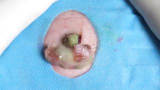 BEST Pimple Popping __ Big Cystic Acne Blackheads __ Whiteheads Removal _ Squeezing Pimples _ H#075 - 003